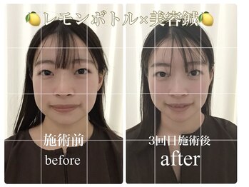 アキュモンド 渋谷院(acumond)/レモンボトル×美容鍼3回の変化