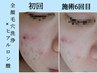 【ハリ×美白】全顔毛穴洗浄+PWヒアルロン酸微弱電流導入+保湿パック