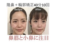 ラプリ 大阪心斎橋店(Raplit)/隆鼻＋輪郭矯正40分10回