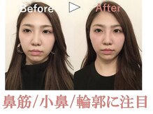 ラプリ 新宿店(Raplit)の雰囲気（顔と鼻を同時に整えます！他の症例もフォトギャラリーに多数あり）