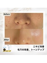 ルアナ(Luana)/セラピールの効果★