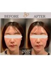 チョコバリ 錦糸町店(chocobari)/小顔×リフトアップ(美容鍼)20代