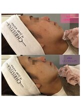 エリー(ERIE)/乳酸菌ピーリング・水分補給