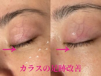 アイリープ(eyeleap)/☆カラスの足跡改善