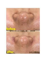 リオンズ 茨城ミスターマックス取手店/毛穴角栓スッキリお試し1回