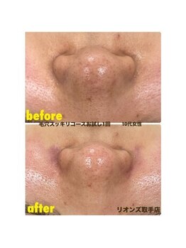 リオンズ 茨城ミスターマックス取手店/毛穴角栓スッキリお試し1回