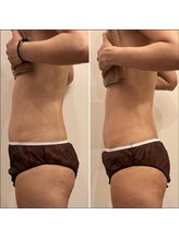 エービューティーサロン 松山店(A BEAUTY SALON.)/30代女性　産後のお腹スリム