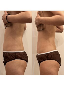 エービューティーサロン 松山店(A BEAUTY SALON.)/30代女性　産後のお腹スリム