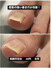 巻き爪じゅん 千葉駅前店/癒着の強い巻き爪の痛みから解放