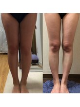 エステティックサロン ピュール ボーテ 東金店/ハイパーナイフ＆セルケア