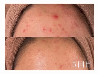 ホワイトアクア 加古川店(WHITE AQUA)/ハーブピーリングで肌荒れ改善