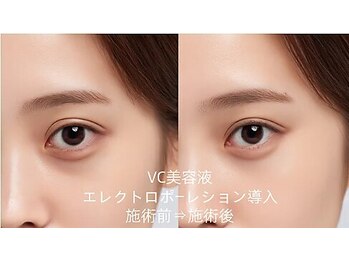 憩いサロン ユリ(yuri)/エレクトロポーレション導入