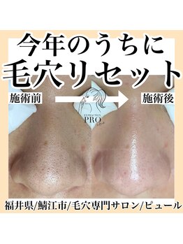 ピュール 鯖江店(PUR)/毛穴/毛穴ケア/毛穴洗浄