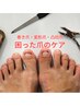【困った爪のケア】厚み凸凹した爪&巻き爪のケア15,950円→15,070円