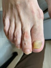 フットメンテ 巻き爪矯正センター 南浦和/陥入爪　施術前