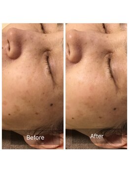 ファヴォリ(favori)/美白美容液導入