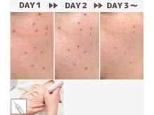 マヴィ くずは店(MavY.)/夏の紫外線シミケア