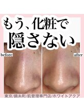 ホワイトアクア 錦糸町店(WHITE AQUA)/ハーブピーリング/東京/錦糸町