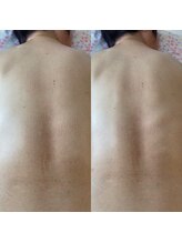 ララルアナ(Lara luana)/辛い背中のハリもケア