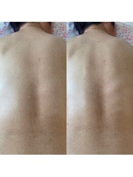 ララルアナ(Lara luana)/辛い背中のハリもケア