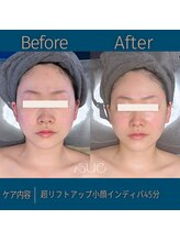 スー(Sue)/リフトアップ小顔インディバ45分