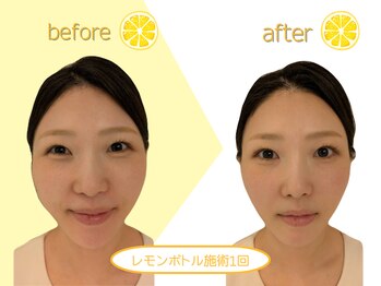 クリニカルエステ イーズ 小倉リバーウォーク北九州デコシティ店/レモンボトルBefore&After