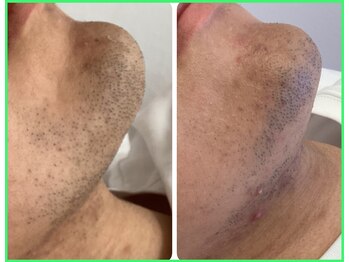 クリア 尾張旭店(Clear)/【Clear脱毛ビフォーアフター】