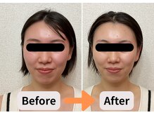 ブプラ 池田店(BUPURA)/赤ら顔・ニキビ☆肌質改善