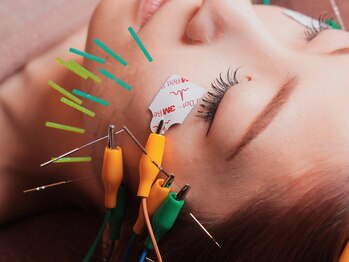 菫鍼灸院の写真/頭皮鍼付き全顔美容鍼で、自然なリフトアップと小顔を叶えます。眼精疲労や食いしばりも同時にケア◎
