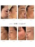 【改善率No.1】濃いシミ&薄いシミ+シミ集中ケア(初回限定)90分 ¥8,800