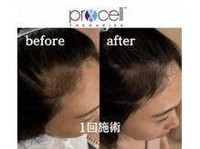 カナウ睡眠頭皮研究ラボ/【育毛促進】施術1回