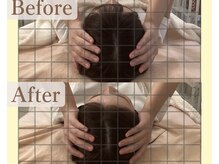 リコ(Rico)/小顔矯正効果☆ビフォーアフター