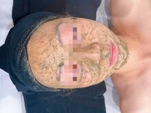 フェザー(feather)/ハーブピーリング