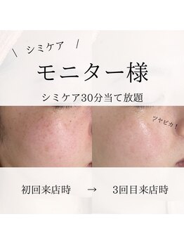 ニコ ウィズ(Nico with)/シミケア◎ビフォーアフター