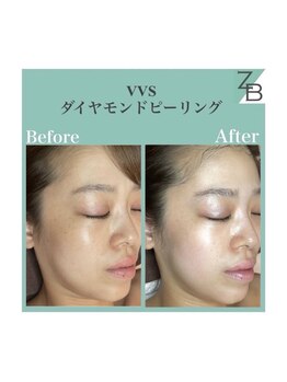ザラハビューティー(ZARAHA Beauty)/VVSダイヤモンドピーリング