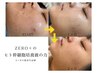 ●ニキビケア肌荒れ紫外線若見えに●ヒト幹細胞＋小顔EMSで最強美肌に￥5500
