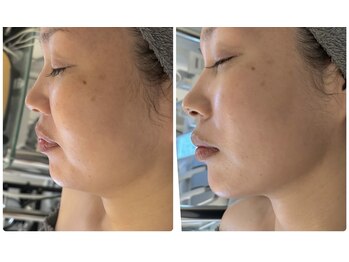 レア(Lea)/小顔リフトアップと肌育が叶う！