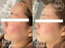 フェイン 青山店(fein.)/高保湿で赤みケア