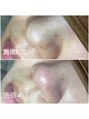 シェリール(cherir) 毛穴洗浄でツルツル毛穴美人!綺麗になりたい方はお任せを◎