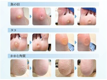 巻き爪補正店 姫路店/角質ケアも行っております!