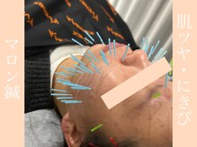 健志接骨院/マロン鍼