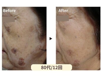 美男美女 奈良三条店/濃いシミにも挑戦