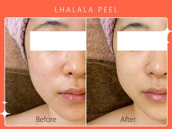 ハノハノ 八代店(HANO HANO)/韓国肌管理ララピール☆