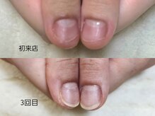 グラシナ なんば店/深爪/自爪育成/フィルイン