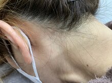 ブリッジ(BRIDGE)/女性うなじ脱毛