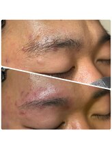 ゴリラアイブロウ 旭川店/古い角質も同時に除去！