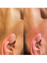 ララルアナ(Lara luana)/うなじ美人脱毛