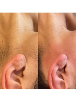 ララルアナ(Lara luana)/うなじ美人脱毛