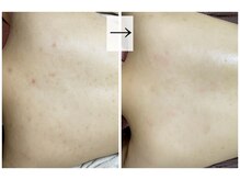 おうちサロン ミキ/背中ニキビ、ポツポツ毛穴ケア