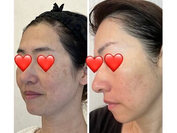 モンドレーヴ(Mondereve)/シミケアコース